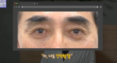 "진작 할걸" 싶은 남자상안검 한끗차이, 사진으로 확인하세요. 사진 15
