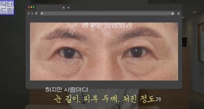 "진작 할걸" 싶은 남자상안검 한끗차이, 사진으로 확인하세요. 사진 10