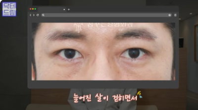 "진작 할걸" 싶은 남자상안검 한끗차이, 사진으로 확인하세요. 사진 6