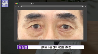 "진작 할걸" 싶은 남자상안검 한끗차이, 사진으로 확인하세요. 사진 16