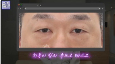 "진작 할걸" 싶은 남자상안검 한끗차이, 사진으로 확인하세요. 사진 7