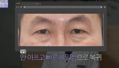 "진작 할걸" 싶은 남자상안검 한끗차이, 사진으로 확인하세요. 사진 13