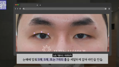 "진작 할걸" 싶은 남자상안검 한끗차이, 사진으로 확인하세요. 사진 11
