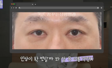 "진작 할걸" 싶은 남자상안검 한끗차이, 사진으로 확인하세요. 사진 8