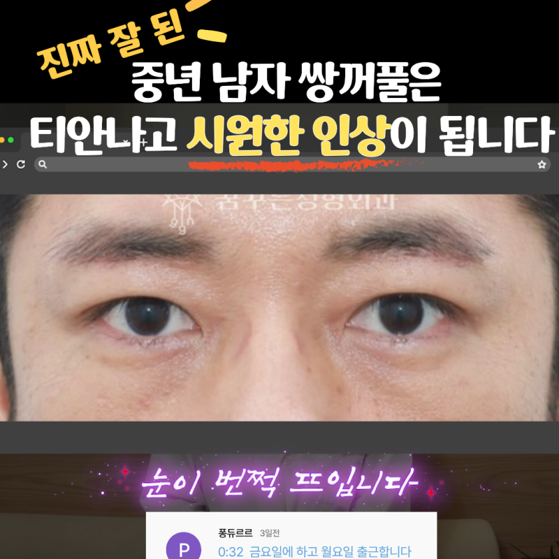 "진작 할걸" 싶은 남자상안검 한끗차이, 사진으로 확인하세요.