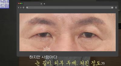 "진작 할걸" 싶은 남자상안검 한끗차이, 사진으로 확인하세요. 사진 9