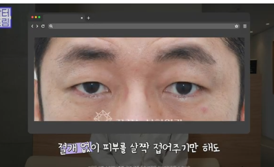 "진작 할걸" 싶은 남자상안검 한끗차이, 사진으로 확인하세요. 사진 5