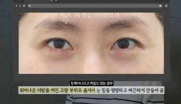 유형별로 다른 눈밑지방재배치 핵심가이드, 실패하는 이유 알고 가세요 사진 8
