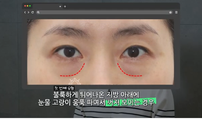 유형별로 다른 눈밑지방재배치 핵심가이드, 실패하는 이유 알고 가세요 사진 3