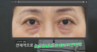 유형별로 다른 눈밑지방재배치 핵심가이드, 실패하는 이유 알고 가세요 사진 6