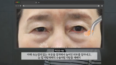 유형별로 다른 눈밑지방재배치 핵심가이드, 실패하는 이유 알고 가세요 사진 15