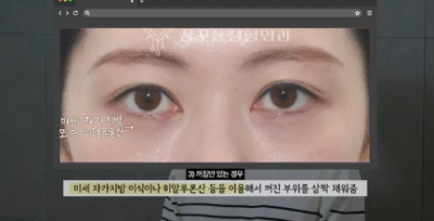 유형별로 다른 눈밑지방재배치 핵심가이드, 실패하는 이유 알고 가세요 사진 9