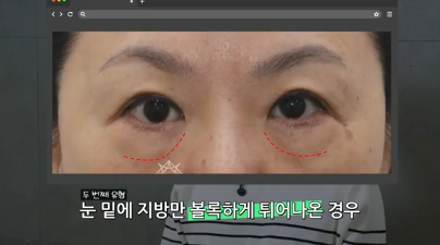 유형별로 다른 눈밑지방재배치 핵심가이드, 실패하는 이유 알고 가세요 사진 4