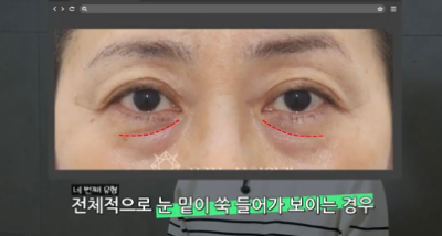 90%가 실패하는 눈밑지방재배치 4가지 이유 사진 9