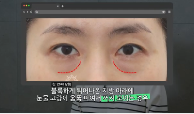 90%가 실패하는 눈밑지방재배치 4가지 이유 사진 3