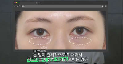 90%가 실패하는 눈밑지방재배치 4가지 이유 사진 7