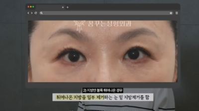 90%가 실패하는 눈밑지방재배치 4가지 이유 사진 6