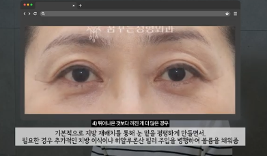 90%가 실패하는 눈밑지방재배치 4가지 이유 사진 10
