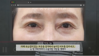 90%가 실패하는 눈밑지방재배치 4가지 이유