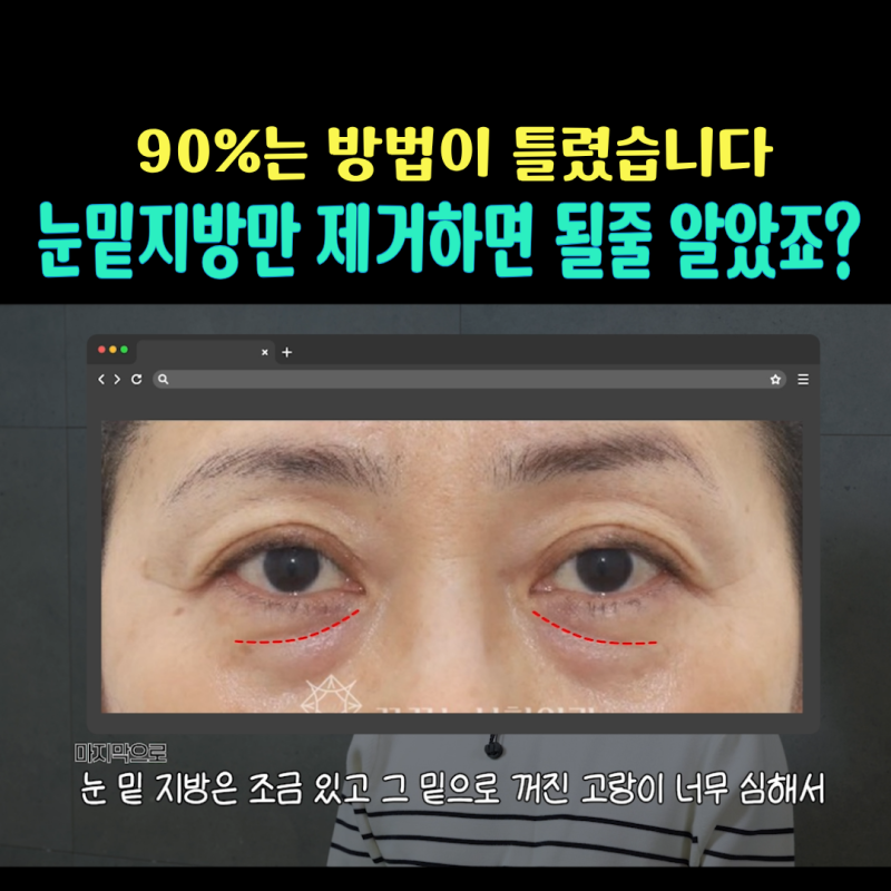90%가 실패하는 눈밑지방재배치 4가지 이유 사진 2
