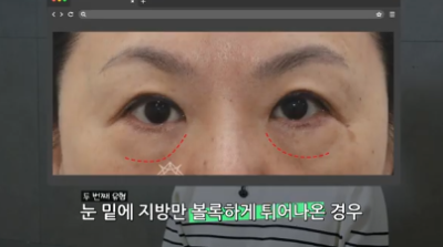 90%가 실패하는 눈밑지방재배치 4가지 이유 사진 5
