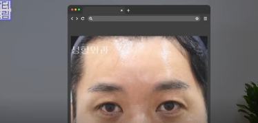 중년쌍꺼풀, 상안검 하면 안되는 눈이 있습니다! 사진 21
