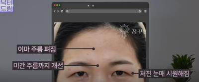 중년쌍꺼풀, 상안검 하면 안되는 눈이 있습니다! 사진 18
