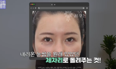 중년쌍꺼풀, 상안검 하면 안되는 눈이 있습니다! 사진 8