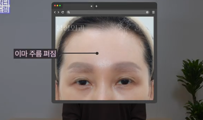 중년쌍꺼풀, 상안검 하면 안되는 눈이 있습니다! 사진 12