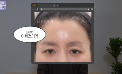 중년쌍꺼풀, 상안검 하면 안되는 눈이 있습니다! 사진 11