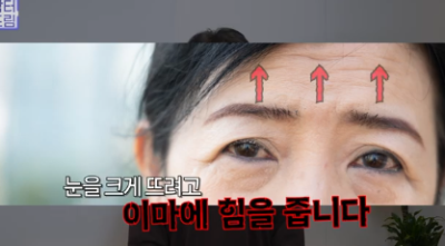 중년쌍꺼풀, 상안검 하면 안되는 눈이 있습니다! 사진 5