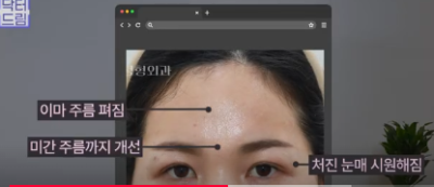 중년쌍꺼풀, 상안검 하면 안되는 눈이 있습니다! 사진 19