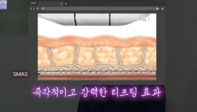 실제로 해보니 정말 효과있었던 탄력레이저는 이겁니다(울쎄라,텐써마,티타늄,온다,포텐자) 사진 4