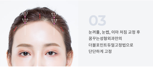 강남역 상안검 수술만으로 부족한 경우? 이마거상이 필요한 눈꺼풀 처짐 특징 사진 8