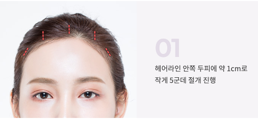 강남역 상안검 수술만으로 부족한 경우? 이마거상이 필요한 눈꺼풀 처짐 특징 사진 6