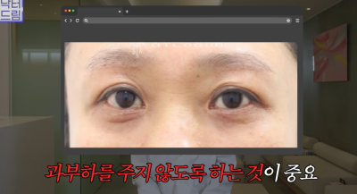 하안검 잘못하고 눈물 흘리는 친구 보고 깨달은 꿀팁 사진 17