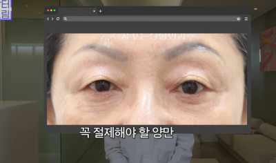 하안검 잘못하고 눈물 흘리는 친구 보고 깨달은 꿀팁 사진 14