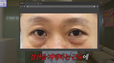 하안검 잘못하고 눈물 흘리는 친구 보고 깨달은 꿀팁 사진 18