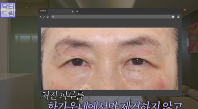 하안검 잘못하고 눈물 흘리는 친구 보고 깨달은 꿀팁 사진 15