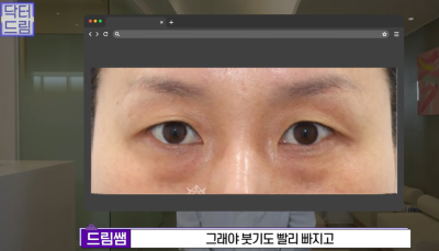 하안검 잘못하고 눈물 흘리는 친구 보고 깨달은 꿀팁 사진 19