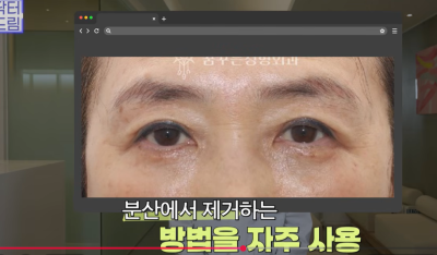 하안검 잘못하고 눈물 흘리는 친구 보고 깨달은 꿀팁 사진 16