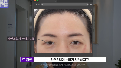 눈 성형 후 사나워진 얼굴, 딱 1가지가 똑같습니다 사진 11