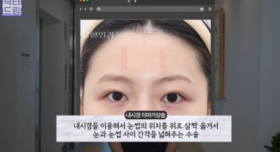 눈 성형 후 사나워진 얼굴, 딱 1가지가 똑같습니다 사진 8