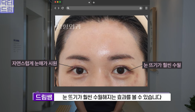 눈 성형 후 사나워진 얼굴, 딱 1가지가 똑같습니다 사진 12