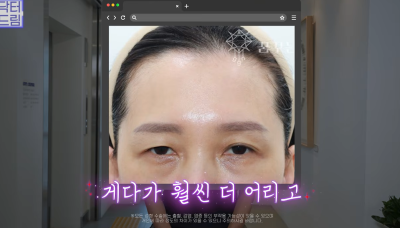 눈 성형 후 사나워진 얼굴, 딱 1가지가 똑같습니다 사진 14