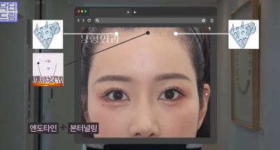 눈 성형 후 사나워진 얼굴, 딱 1가지가 똑같습니다 사진 24