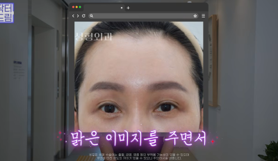 눈 성형 후 사나워진 얼굴, 딱 1가지가 똑같습니다 사진 13