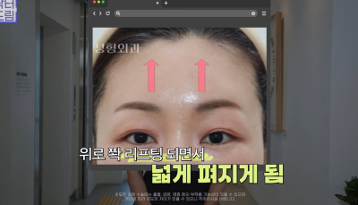 눈 성형 후 사나워진 얼굴, 딱 1가지가 똑같습니다 사진 10