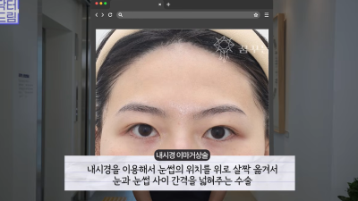 눈 성형 후 사나워진 얼굴, 딱 1가지가 똑같습니다