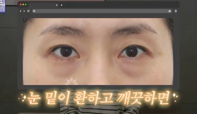 전현무도 한 중년수술, 이게 현실입니다 사진 4